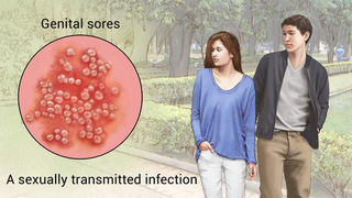Illustration for article titled Perawatan Herpes Kelamin Mudah Ampuh